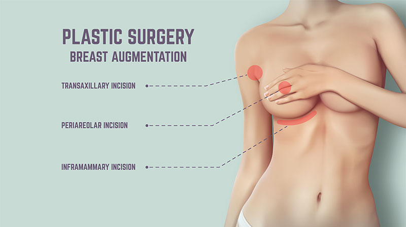 Breast augmentation - plastic surgery